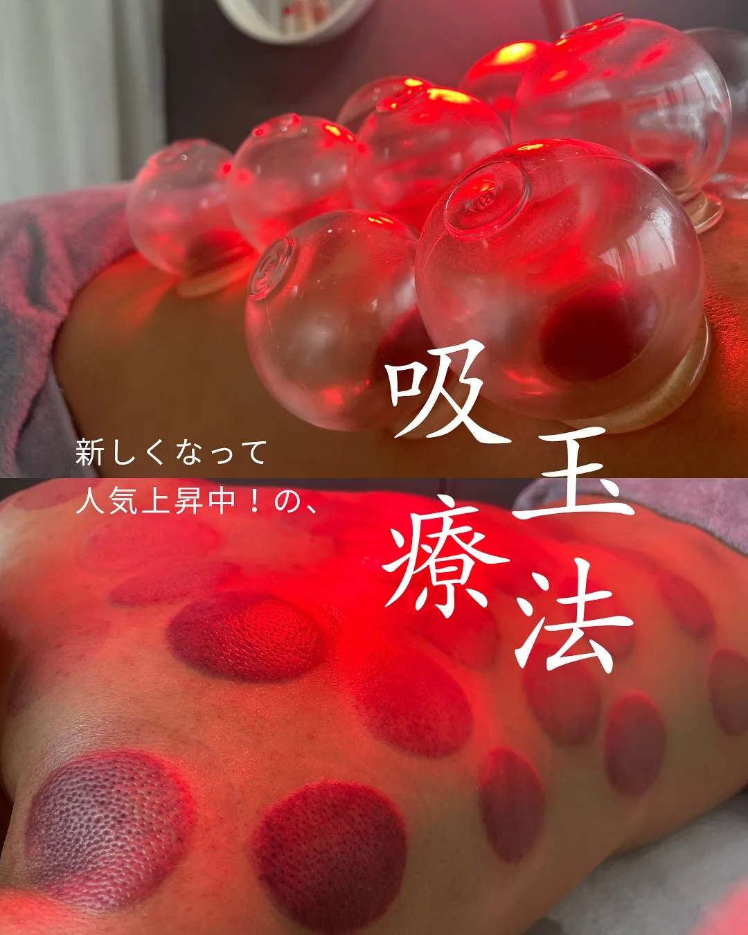 新しくなって人気上昇中！🔥の『吸玉療法』