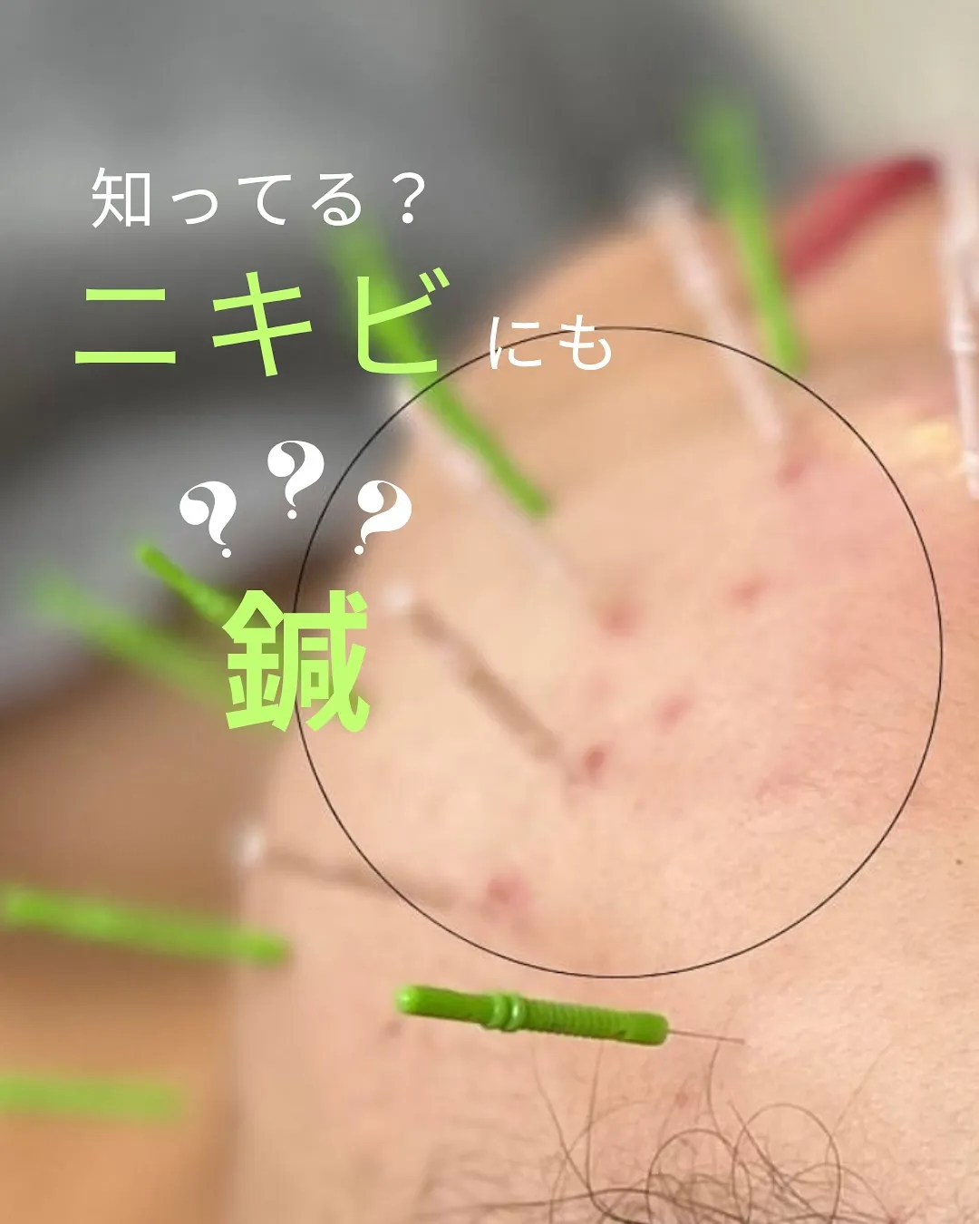 ニキビにも鍼できるって知ってる？🤔🗯