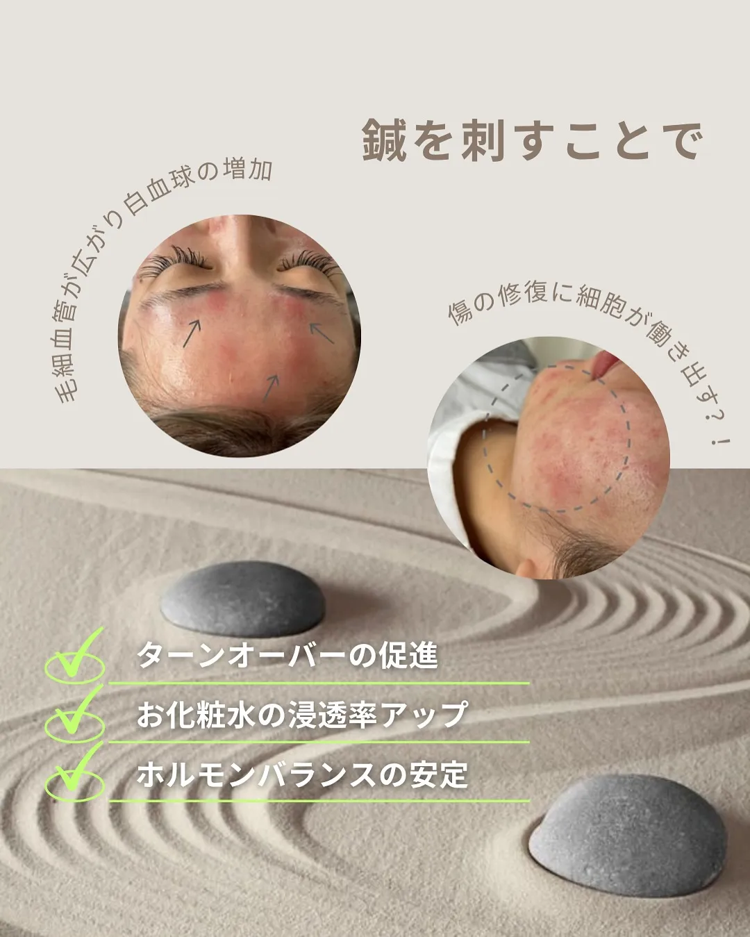 ニキビにも鍼できるって知ってる？🤔🗯