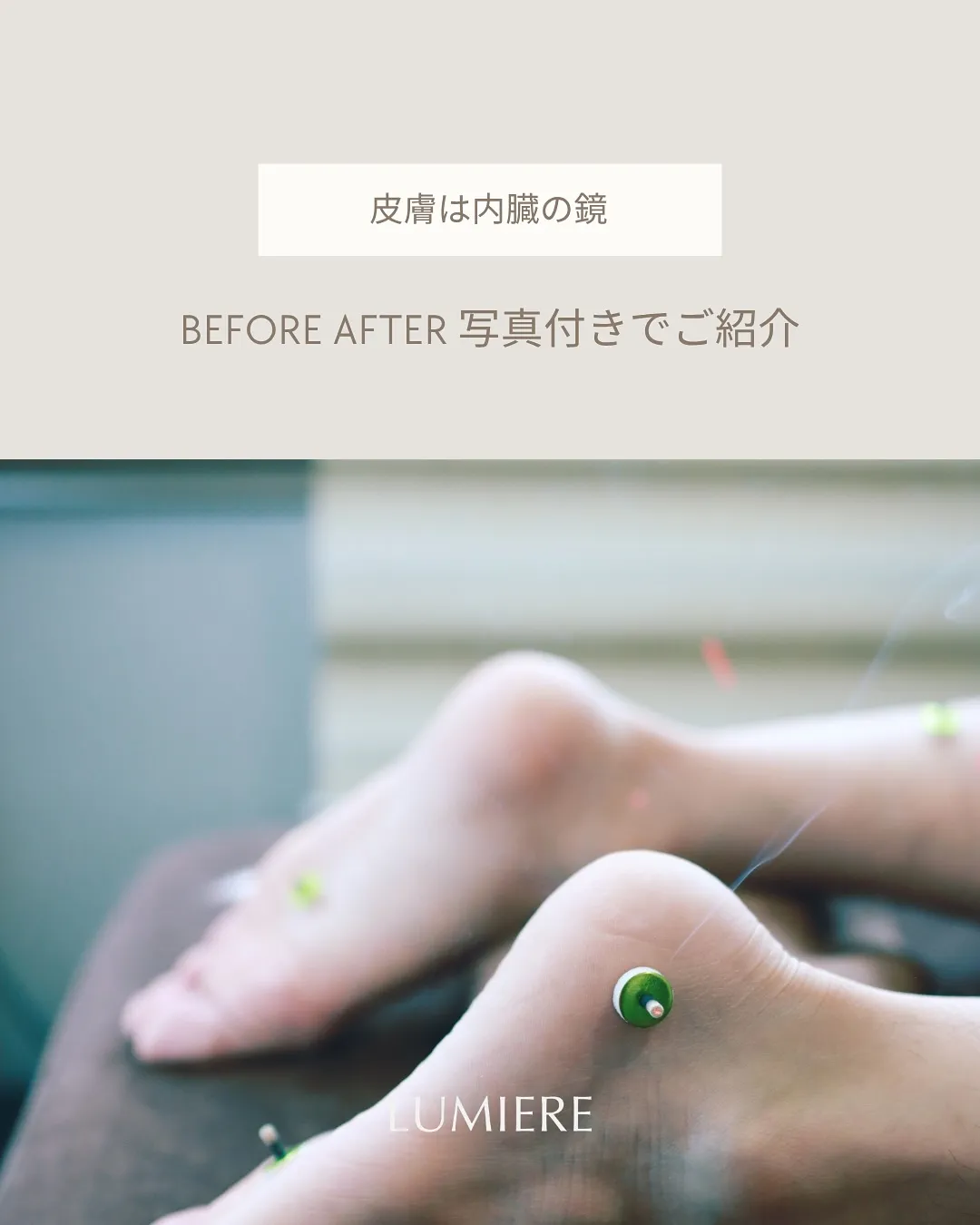 手掌紅斑（しゅしょうこうはん）って知ってる🤔❓