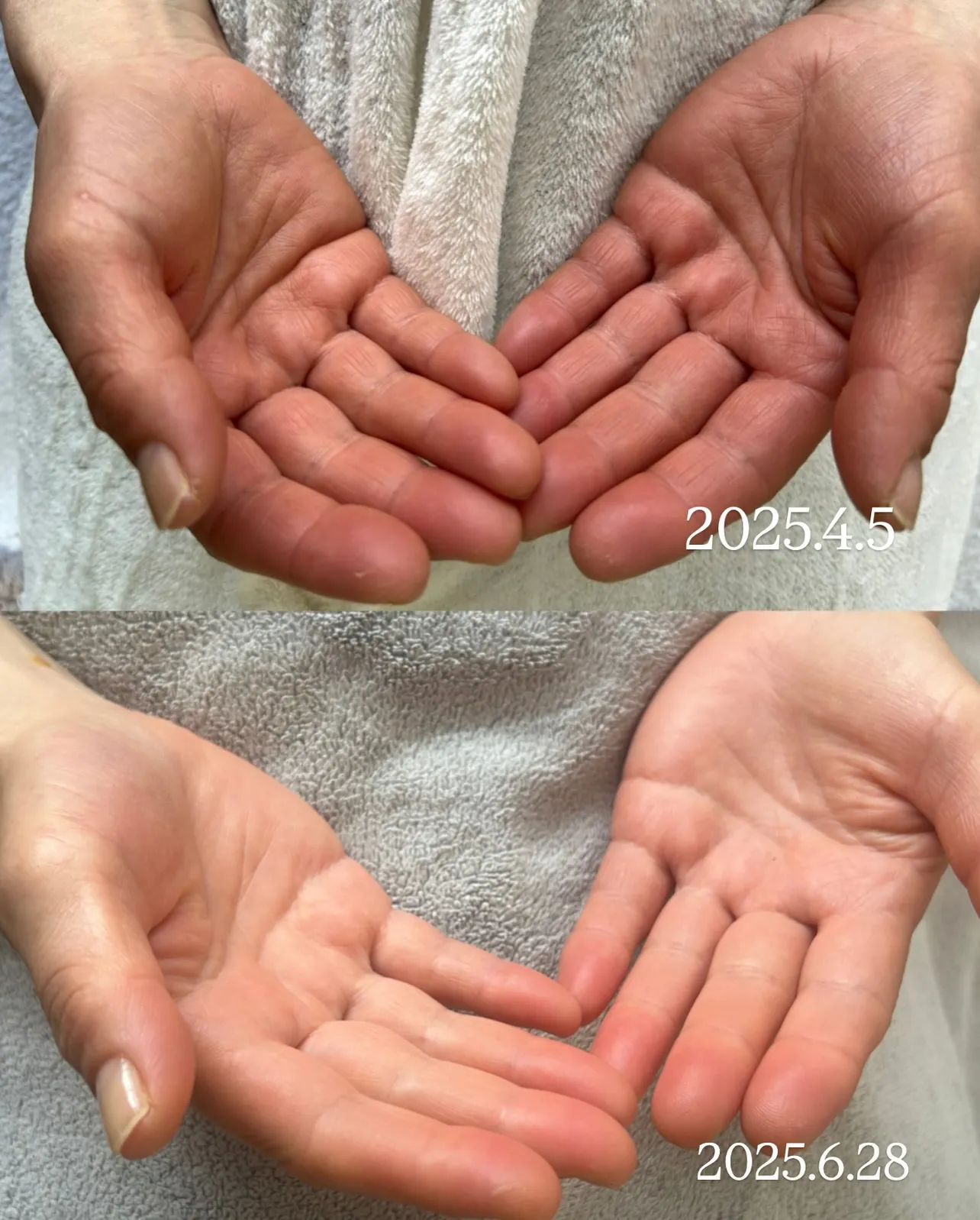 手掌紅斑（しゅしょうこうはん）って知ってる🤔❓