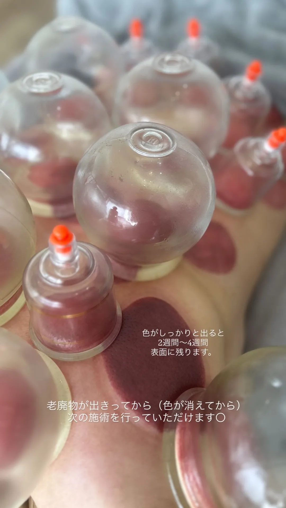 【岡山・倉敷エリア】鍼灸施術と吸玉が受けられるサロン