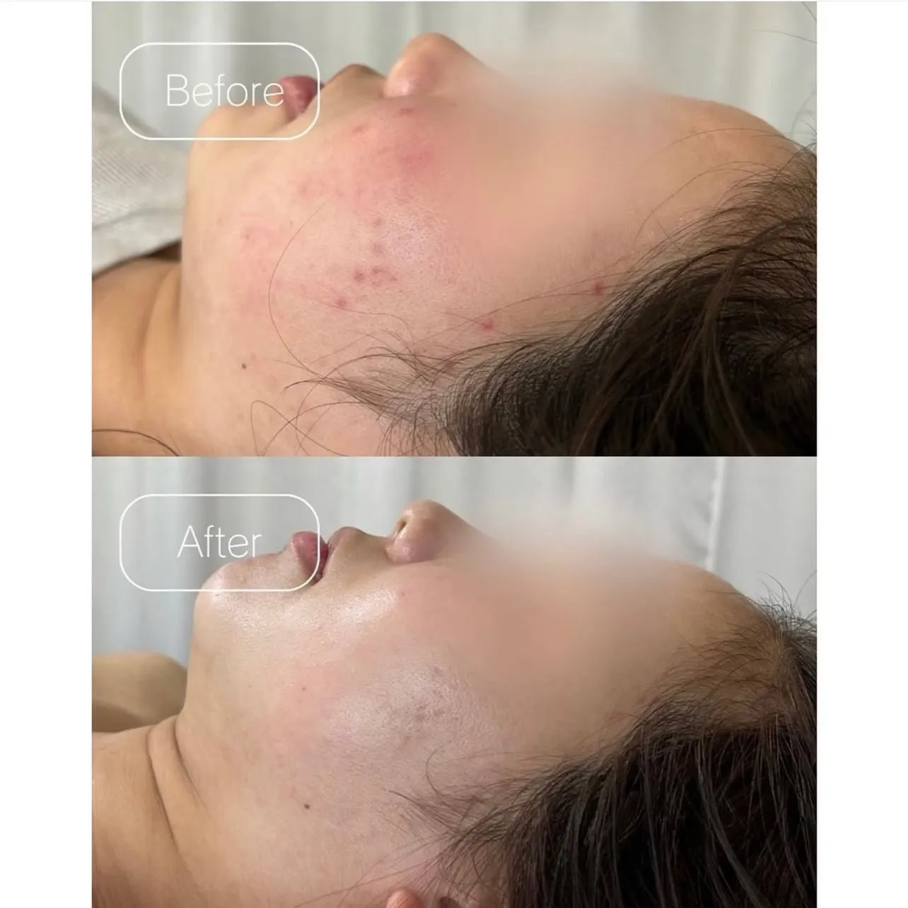 美容医療の前にオーガニックエステの選択を🥣