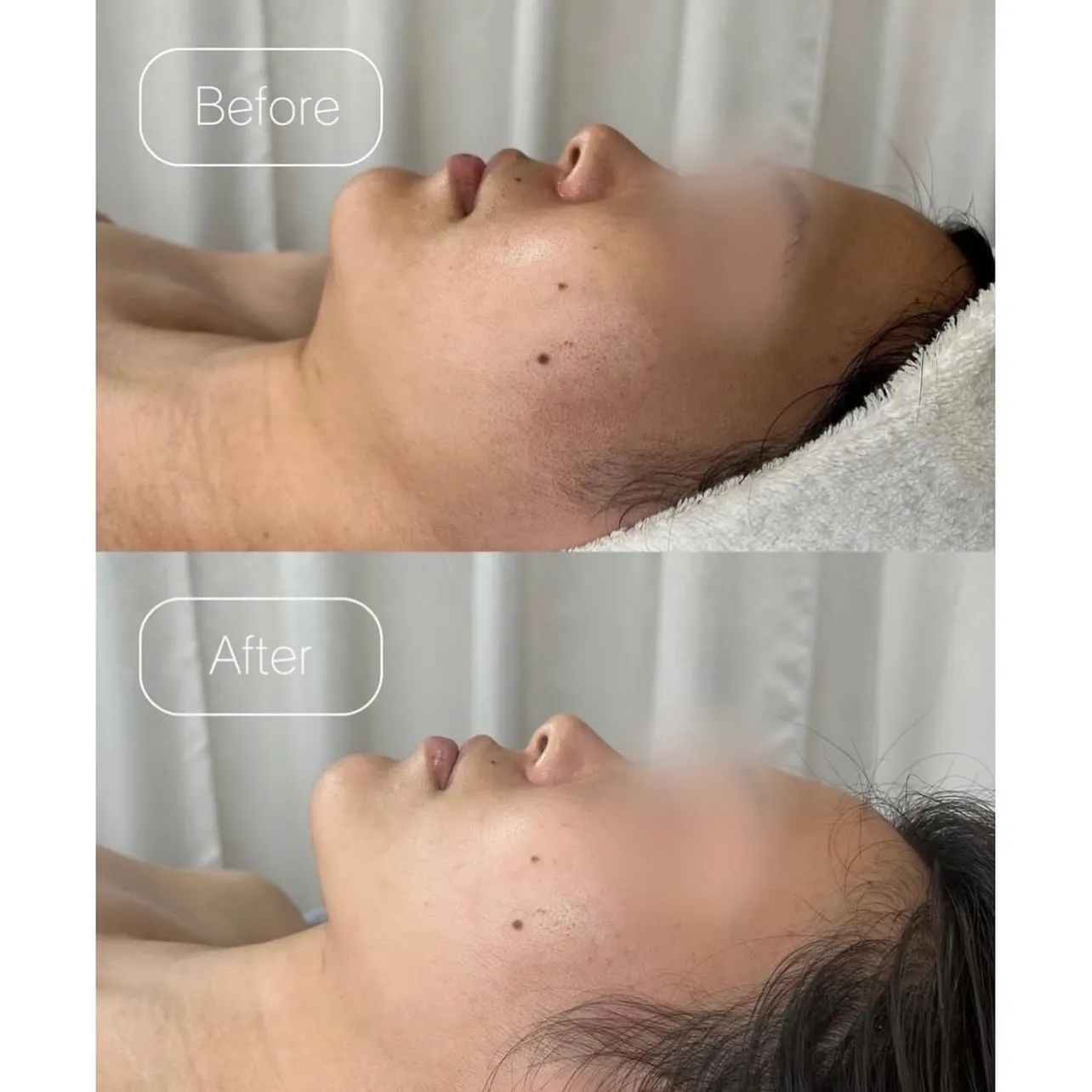 美容医療の前にオーガニックエステの選択を🥣