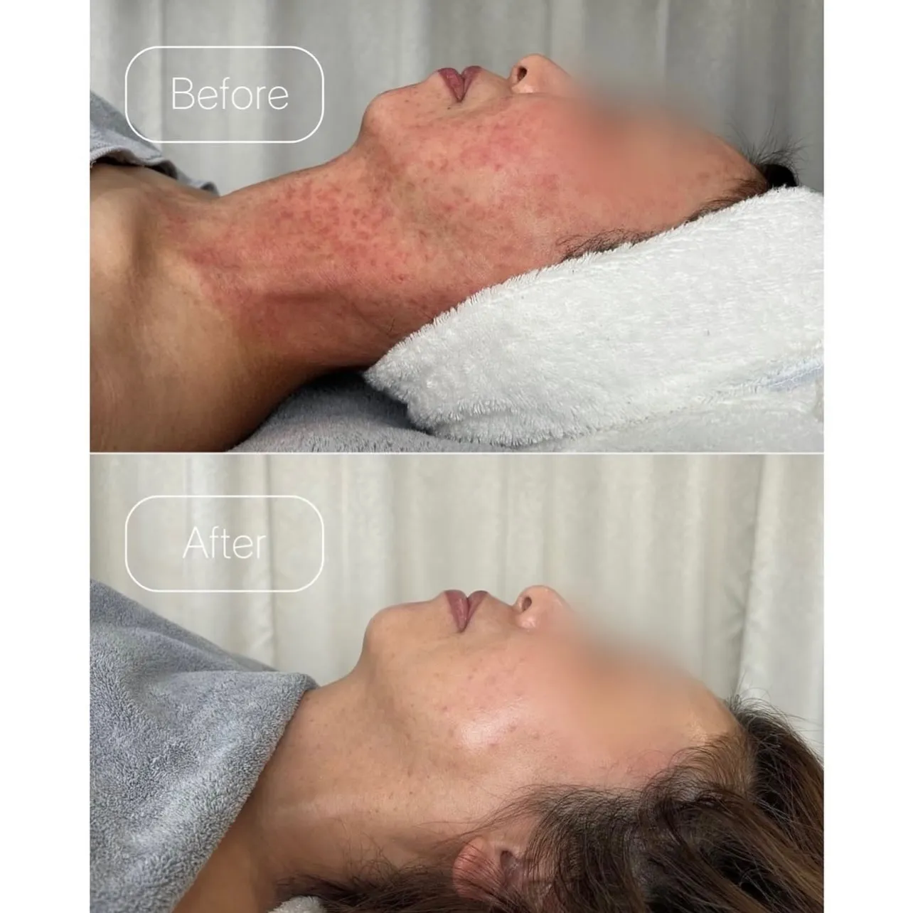 美容医療の前にオーガニックエステの選択を🥣