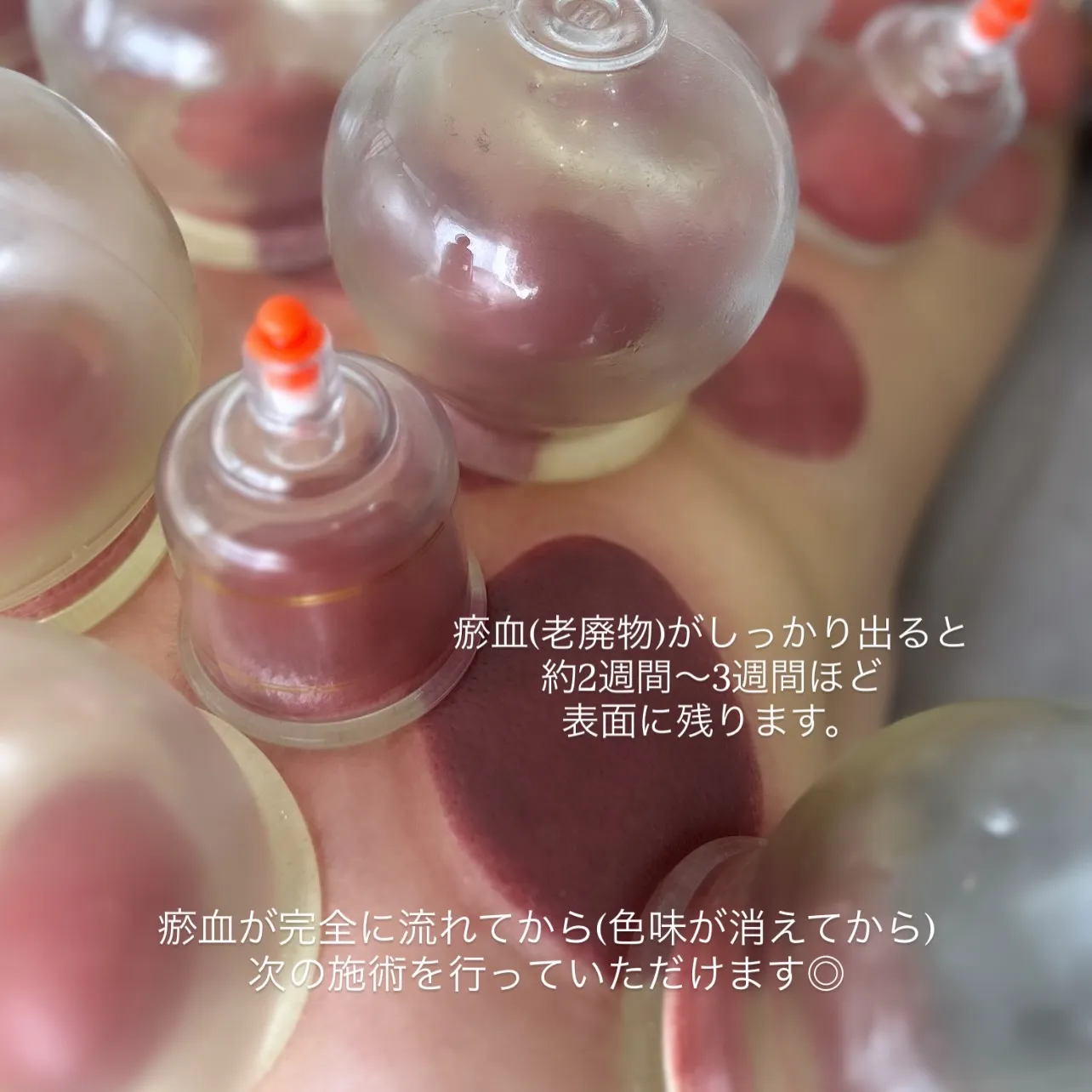 大人気オプションの吸玉🇯🇵✨